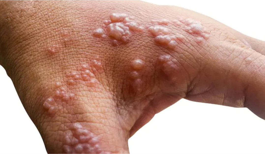 Abia confirms 9 cases of Monkey Pox