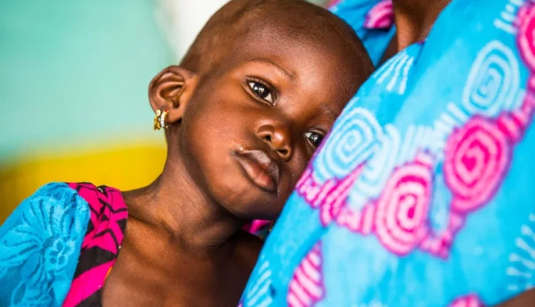 Malnutrition: UNICEF to train Adamawa health workers