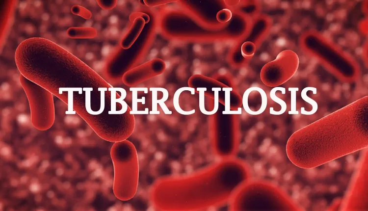 Bauchi State detects 7,806 cases of tuberculosis