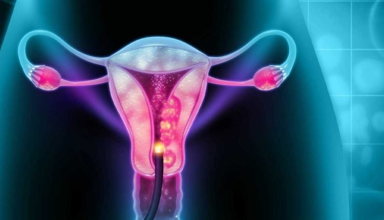 Cervical Cancer: Oncologist advises yearly screening