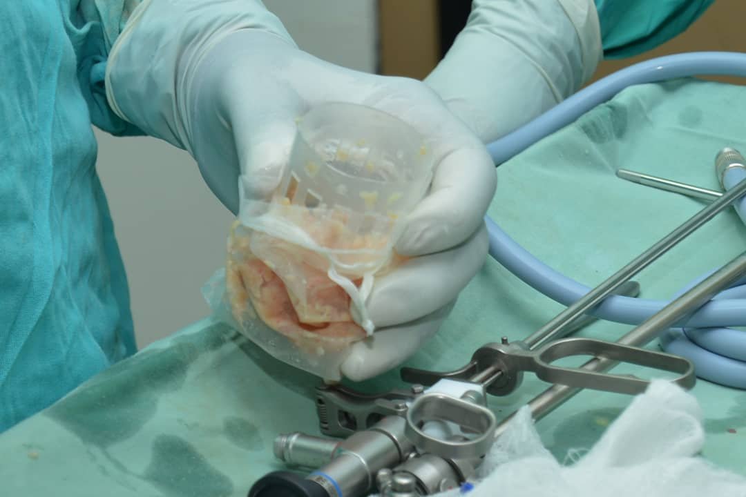 AKTH performs first kidney transplant with laser technology