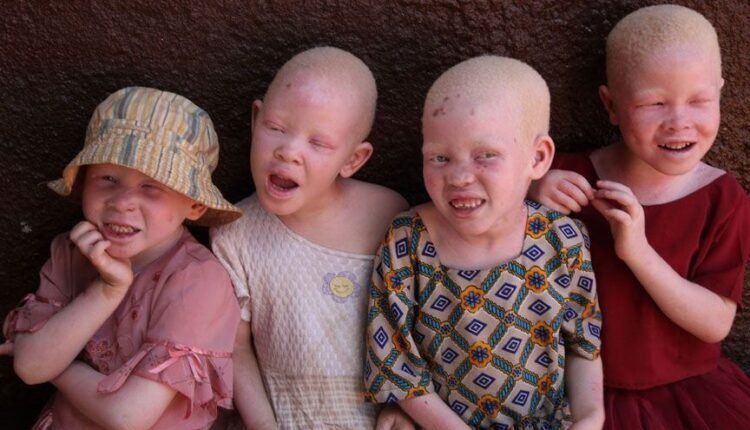 Analysis: Nigerian Albinos and struggle against skin cancer