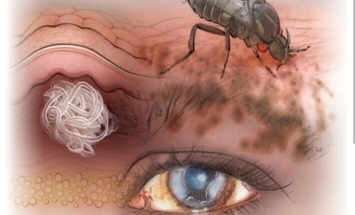 Expert urges early treatment as river blindness threatens vision